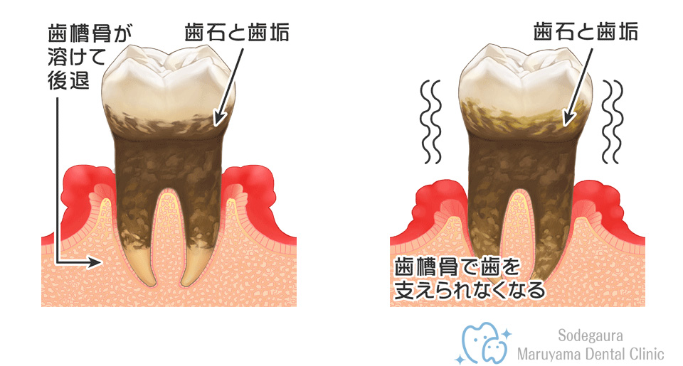 歯ぐきの腫れ　歯周病治療　袖ヶ浦丸山歯科