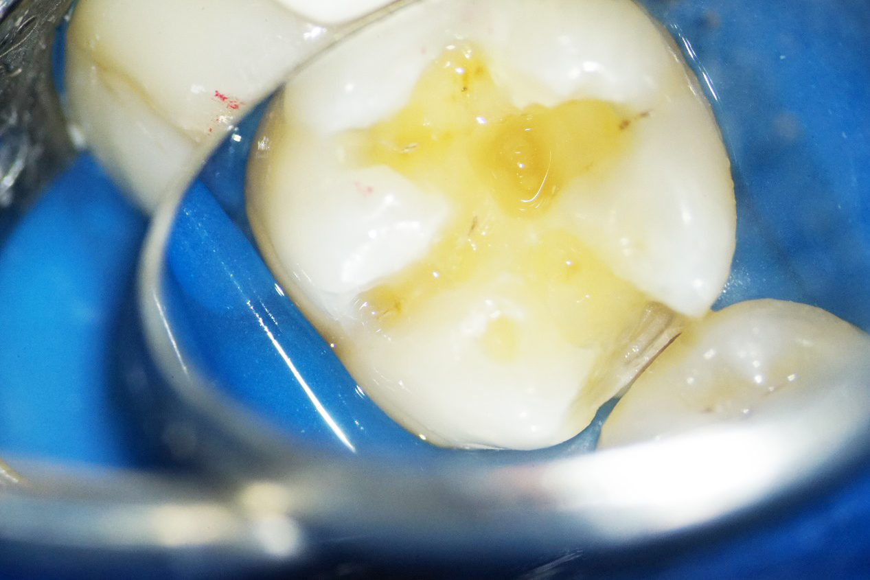 マイクロスコープで拡大しながら歯を削ります 袖ケ浦駅前まるやま歯科こども歯科