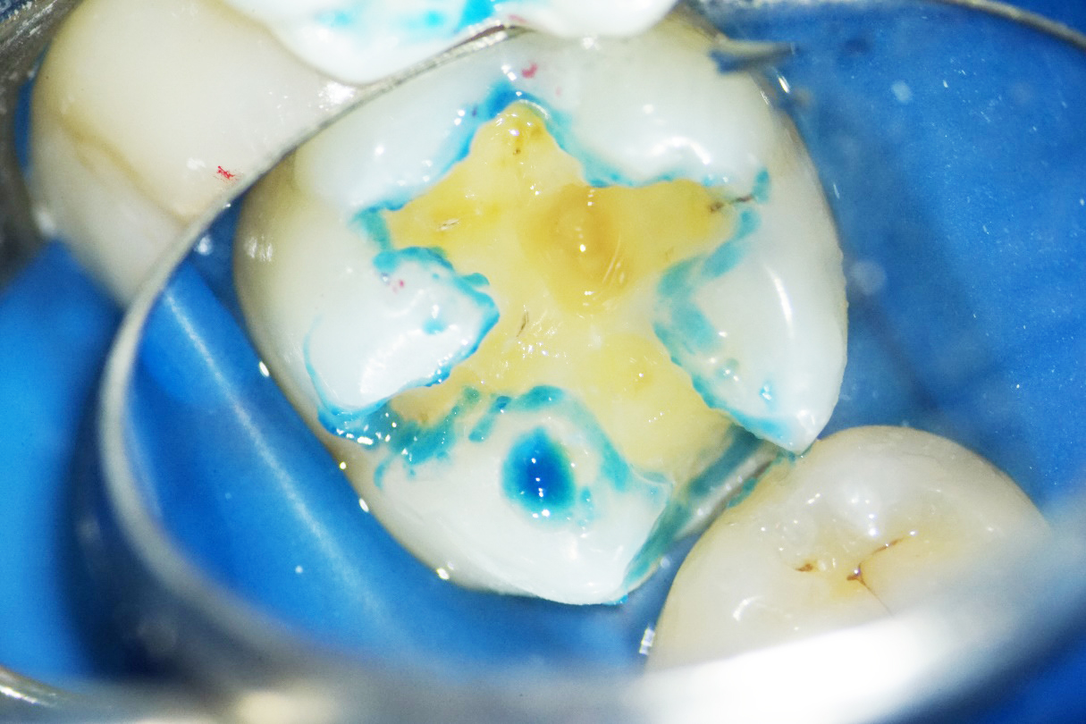 詰め物を入れる際の下処理 袖ケ浦駅前まるやま歯科こども歯科