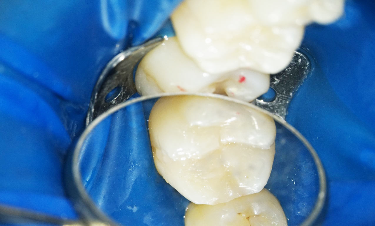 詰め物を詰める際にラバーダムを使用することで再治療のリスクを軽減する 袖ケ浦駅前まるやま歯科こども歯科