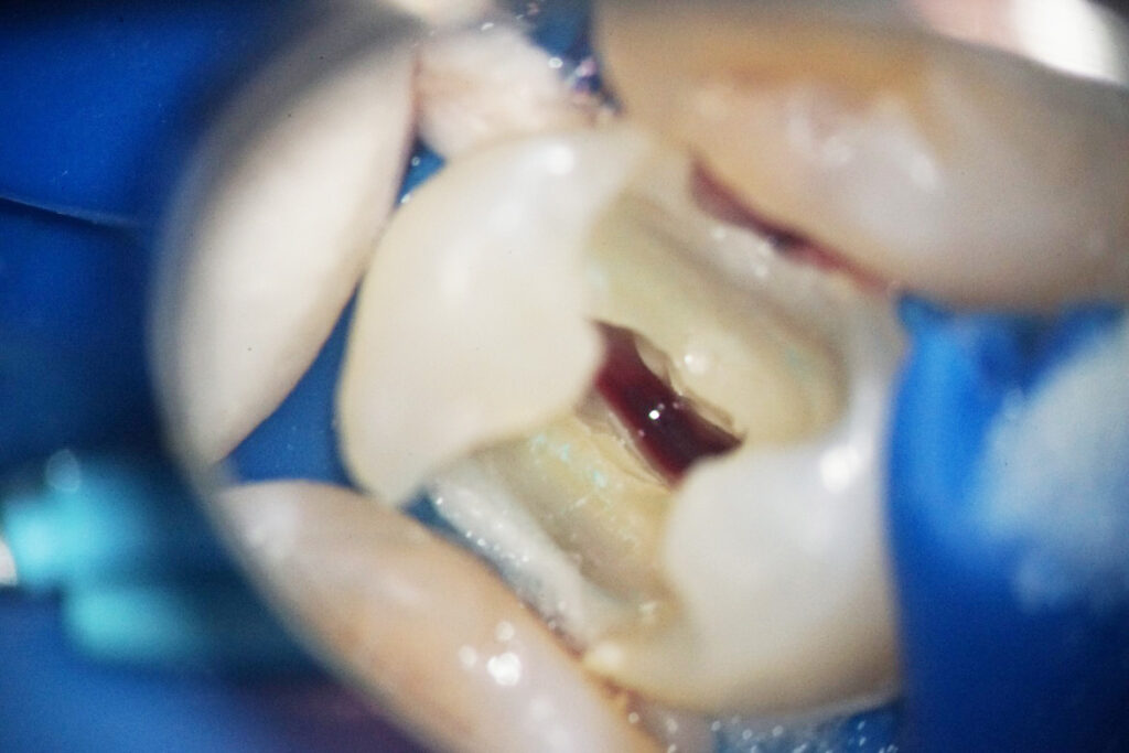 歯髄温存療法 虫歯が神経に達してしまった状態 袖ケ浦駅前まるやま歯科こども歯科