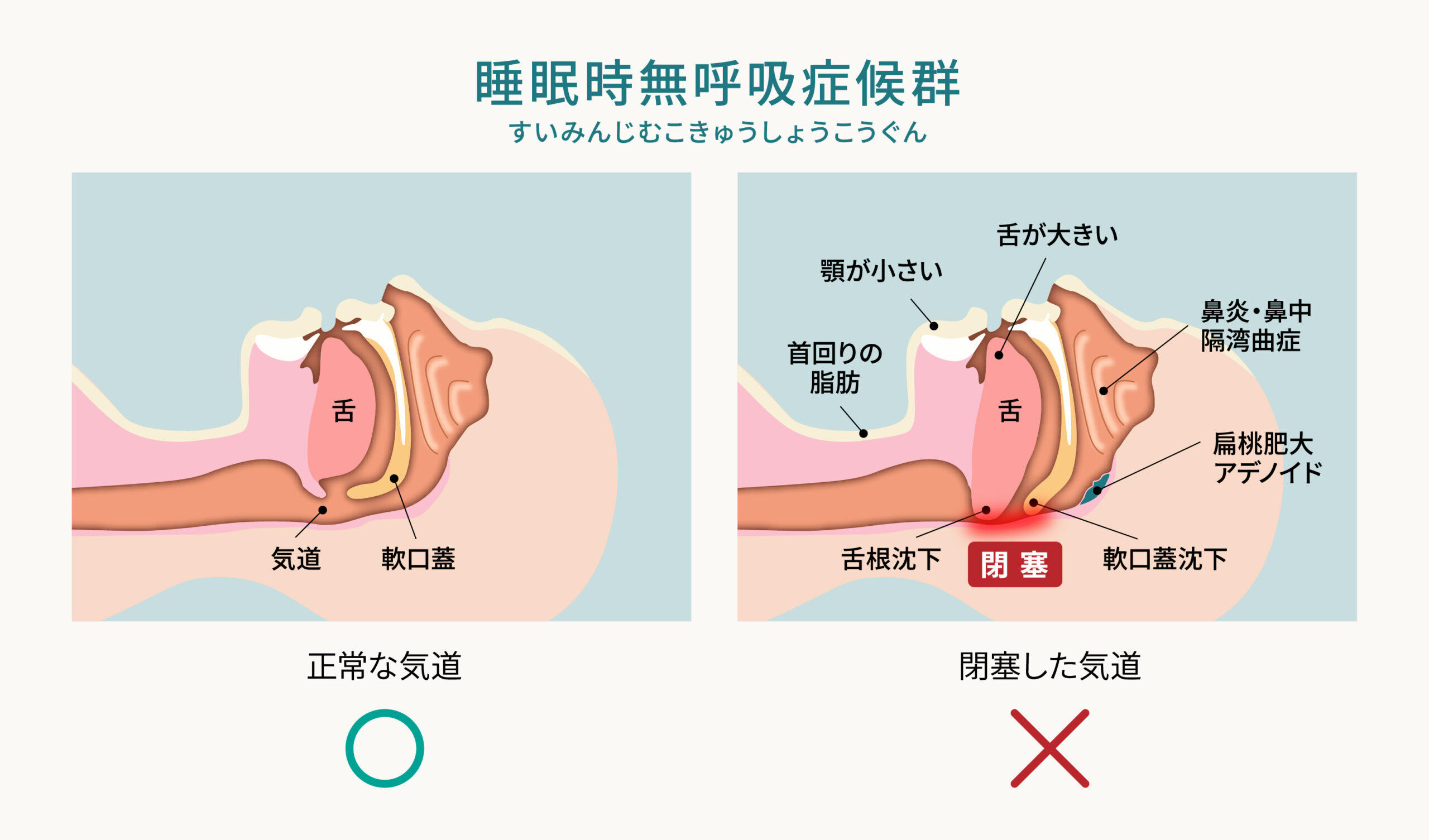 正常な気道と閉塞した気道の比較 睡眠時無呼吸症候群