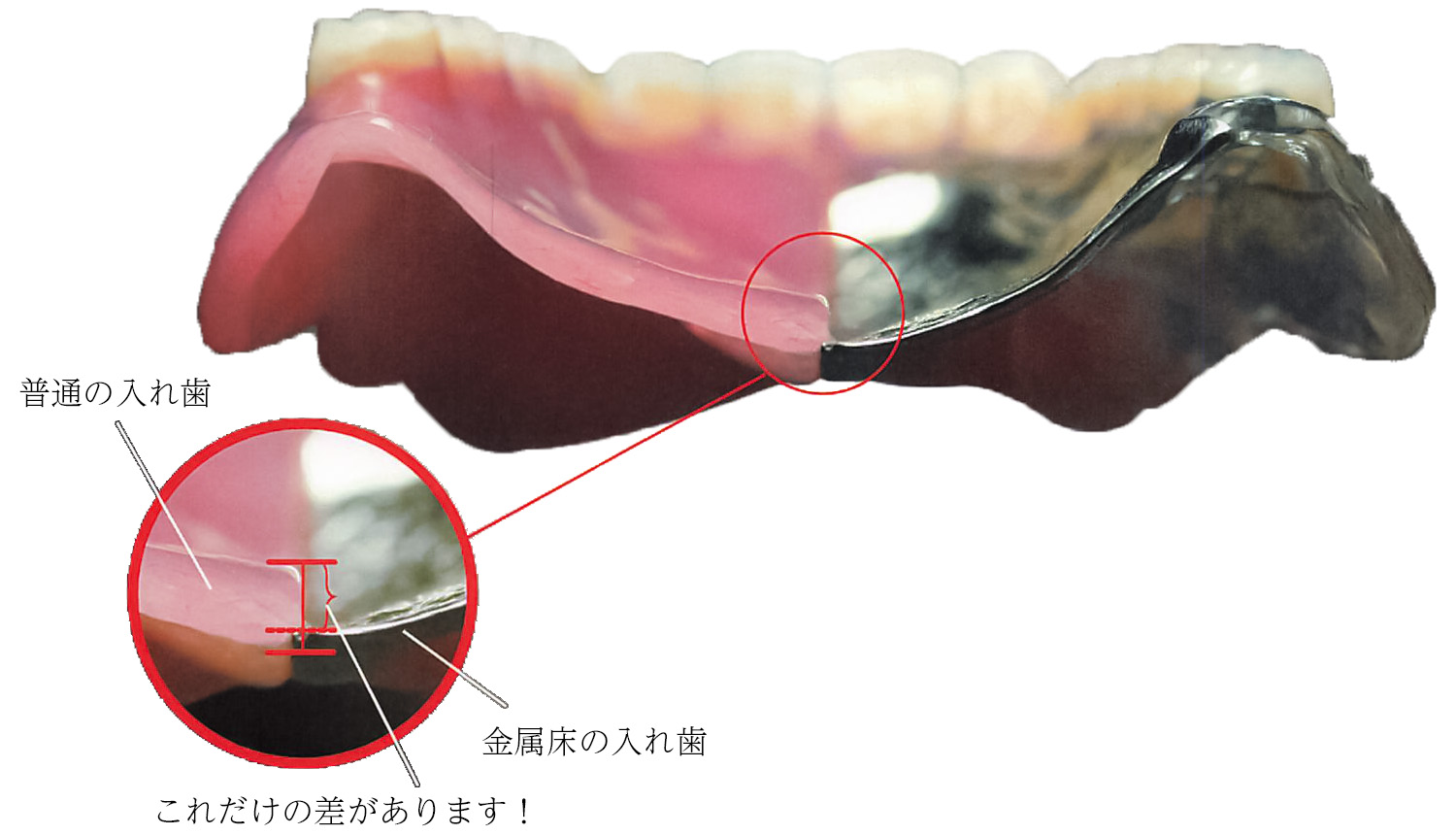 金属床と普通の入れ歯の厚みの比較画像